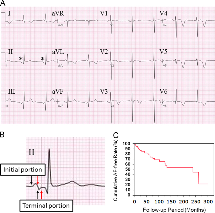 Biphasic P wave in inferior leads and the development of atrial ...