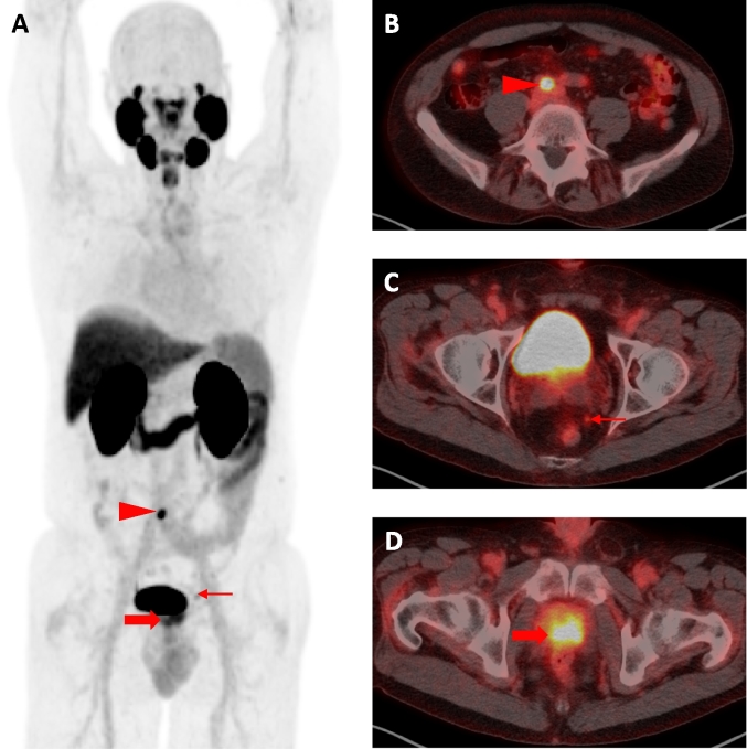 Psma-targeted [18f]dcfpyl Pet Ct-avid Lesions In A Patient With 