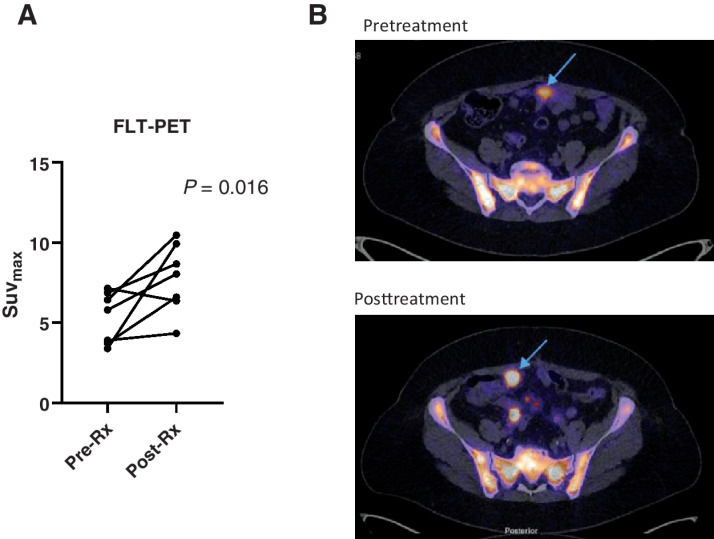 Figure 2. Pharmacodynamic studies of CT900. A, Results in seven patients showing difference in SUVmax in pre- and post-treatment scans. B, Representative images of a patient's 18F-FLT PET/CT scan showing increase in uptake of FLT in tumor in posttreatment.