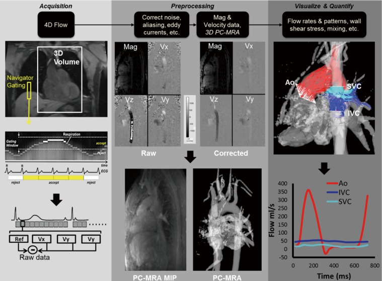 4D flow imaging with MRI - PMC