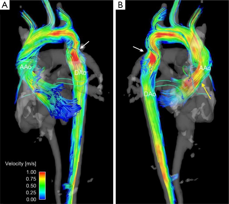 4D flow imaging with MRI - PMC