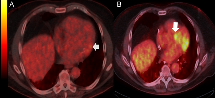 Bidirectional Ventricular Tachycardia In Cardiac Sarcoidosis - Pmc