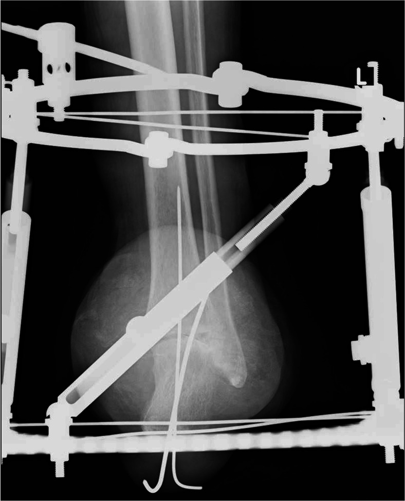 Rehabilitation of a Patient with Pirogoff Amputation and Two-year ...