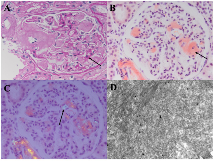 Serum Amyloid A Protein–Associated Kidney Disease: Presentation ...