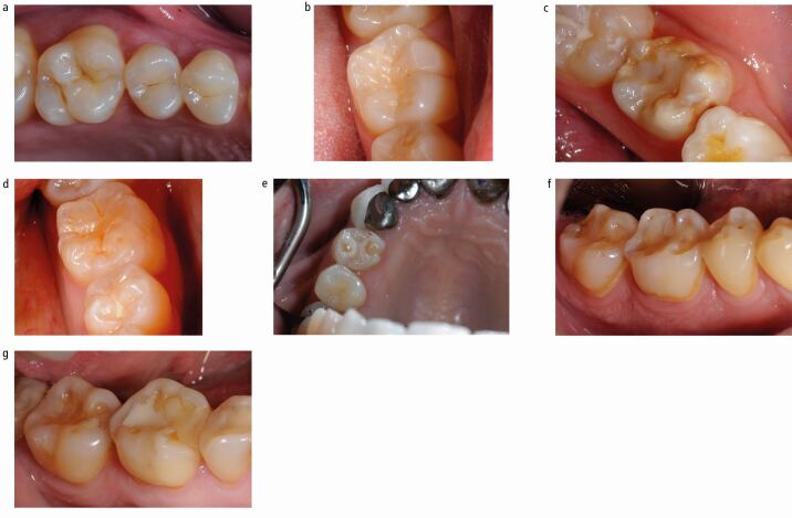 Recommendations and guidelines for dentists using the basic erosive ...