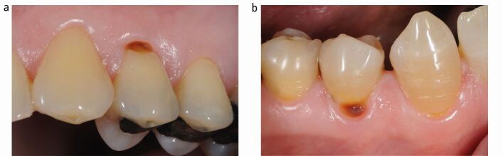 Recommendations and guidelines for dentists using the basic erosive ...