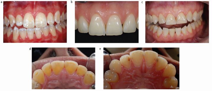 Recommendations and guidelines for dentists using the basic erosive ...