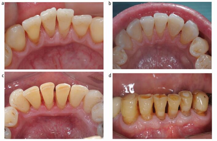 Recommendations and guidelines for dentists using the basic erosive ...