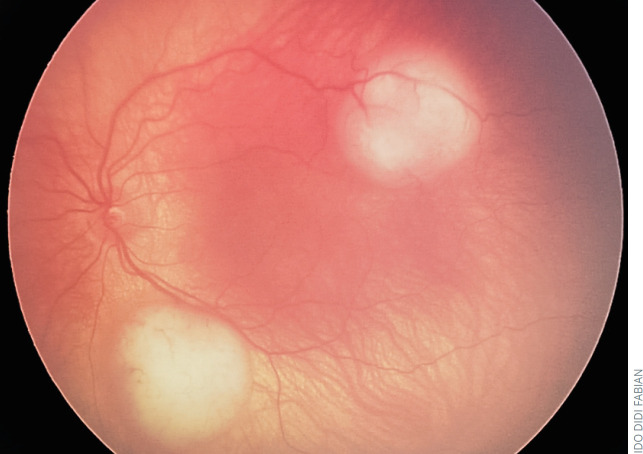 Understanding retinoblastoma: epidemiology and genetics - PMC