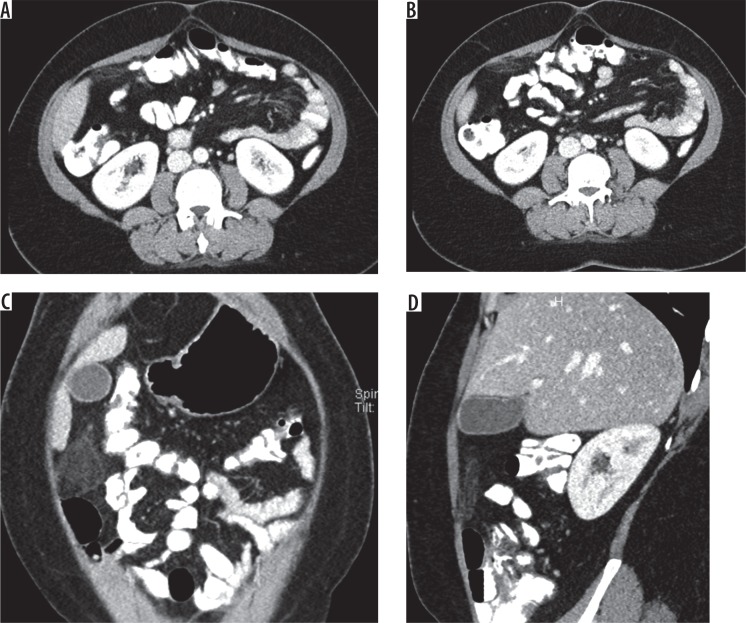 Multislice computed tomography evaluation of primary abdominal fat ...