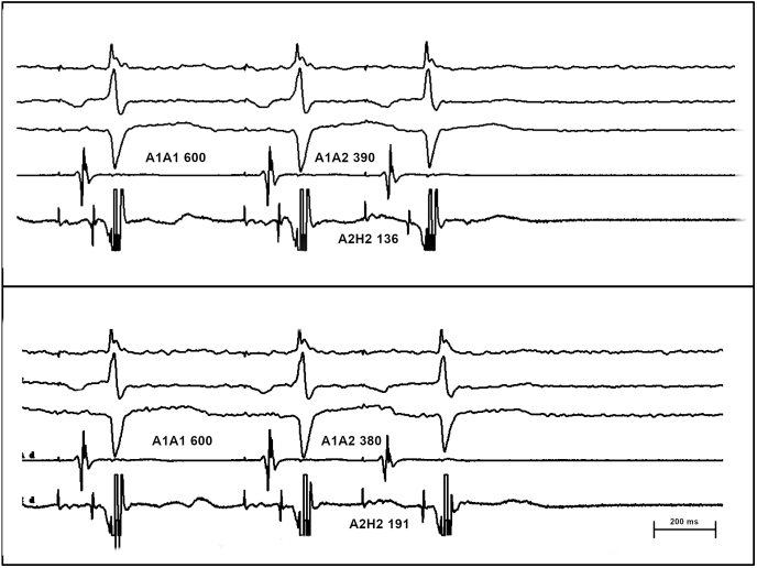 Coumel's Sign Reversed: What Is The Mechanism? - PMC