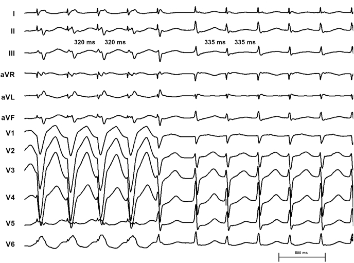 Coumel's Sign Reversed: What Is The Mechanism? - PMC