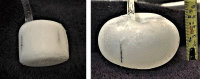 Cervical balloon pre-inflation, left, and postinflation, right, showing preferential inflation in the radial direction. Initial height is 3 cm and initial diameter is 4 cm. Final height is 5 cm and final diameter is 8.5 cm.