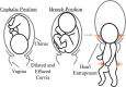 Schematic of the cephalic position, breech position, and head entrapment with anatomy labeled