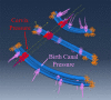 abaqus model of cervical retractor with locations of the pressure experienced while holding open the cervix and birth canal