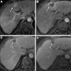 Liver Imaging Reporting and Data System (LI-RADS) treatment response
(LR-TR) Nonprogressing. Images in a 54-year-old male patient with hepatitis
C and alcohol-related cirrhosis presenting with an α-fetoprotein
level of 143 ng/mL and a 3.8-cm segment IV observation with (A) arterial
phase hyperenhancement (arrow) and washout and capsule (not shown),
categorized as LI-RADS 5. (B) MRI arterial phase scan 1 month after
transarterial radioembolization, with an α-fetoprotein level of 12.5
ng/mL, shows minimal residual intralesional enhancement (11 o’clock
position) and smooth perilesional rim enhancement (arrow), yielding LR-TR
Nonprogressing. (C) On the MRI arterial phase scan 5 months after
transarterial radioembolization, the treatment cavity was smaller, with
decreasing intralesional enhancement and smooth perilesional rim enhancement
(arrow), yielding LR-TR Nonprogressing. (D) On the MRI arterial phase scan
18 months after transarterial radioembolization, there was no residual
intralesional enhancement, and the treatment cavity had decreased in size
(arrow), yielding LR-TR Nonviable. Note the overlying capsular retraction
from radiation fibrosis, an expected finding after transarterial
radioembolization.