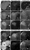 Liver Imaging Reporting and Data System treatment response (LR-TR)
Viable after stereotactic body radiation therapy (SBRT). Pretreatment MRI
scans in an 89-year-old female patient with hepatitis C–related
cirrhosis presenting with 3.6-cm biopsy-proven hepatocellular carcinoma show
(A) arterial phase peripheral rim enhancement and heterogeneous central
enhancement (arrow), with (B) restricted diffusion (arrow) and (C) mild
hyperintense T2-weighted signal (arrow), yielding category LR-M.
(D–F) MRI scans acquired 3 months after stereotactic body radiation
therapy show the treated lesion measuring 2.0 cm, with (D) persistent
irregular masslike enhancement in the lesion with surrounding parenchymal
perfusional changes related to postradiation changes (arrow), (E) mild
restricted diffusion (arrow), and (F) mild persistent T2-weighted
hyperintense signal (arrow), yielding LR-TR Nonprogressing. On MRI scans (G)
6 and (J) 12 months after stereotactic body radiation therapy, the treated
observation measures 1.4 cm and 1.5 cm, respectively, with no intralesional
enhancement but increasing parenchymal fibrosis (arrow), (H, K) loss of
restricted diffusion (arrow), and (I, L) decreasing T2-weighted
hyperintensity (arrow), yielding LR-TR Nonviable at both time points.
(M–O) Fifteen-month follow-up MRI scans show interval increase in
size of the treatment cavity, measuring 2.7 cm with (M) new intralesional
enhancement (arrow), (N) areas of increased restricted diffusion (arrow),
and (O) T2-weighted hyperintense signal corresponding to the areas of new
internal enhancement (arrow), yielding LR-TR Viable.