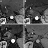Liver Imaging Reporting and Data System treatment response (LR-TR)
Nonprogressing. MRI arterial phase scan in a 74-year-old male patient with
history of right segmentectomy for hepatocellular carcinoma, presenting with
a new 1.4-cm observation in the caudate, shows (A) arterial phase
hyperenhancement (arrow); washout was also observed (not shown). (B) MRI
arterial phase scan 3 months after stereotactic body radiation therapy shows
persistent irregular masslike enhancement of the treated lesion with
associated parenchymal perfusional enhancement (arrow), yielding LR-TR
Nonprogressing. (C) MRI arterial phase 6-month follow-up scan shows
decreasing size and enhancement of the treated observation with surrounding
parenchymal perfusional changes (arrow), consistent with expected
postradiation fibrosis, yielding LR-TR Nonprogressing. (D) MRI arterial
phase 12-month follow-up scan shows progressive atrophy of caudate with no
intralesional enhancement (arrow), yielding LR-TR Nonviable.