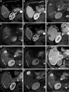 Liver Imaging Reporting and Data System (LI-RADS) treatment response
(LR-TR) Equivocal after microwave ablation. MRI scans in a 76-year-old
female patient with alcohol-related cirrhosis show a 1.7-cm segment VI
observation demonstrating (A) arterial phase hyperenhancement (arrow), (B)
washout and capsule (arrow), (C) mild T2 hyperintense signal (arrow), and
(D) restricted diffusion (arrow), categorized as LI-RADS 5. (E) MRI scan 3
months after microwave ablation shows irregular perilesional rim enhancement
on arterial phase (arrow), while the (F) corresponding portal venous phase
image shows no finding (arrow). (G) T2-weighted image shows subtle
corresponding mild hyperintense signal (arrow) with (H) restricted diffusion
(arrow). In Treatment Response Assessment version 2017, this would be LR-TR
Equivocal; however, in version 2023, this can be upgraded to LR-TR Viable
based on the presence of ancillary features. (I) Precontrast T1-weighted MRI
scan 6 months after microwave ablation shows central coagulation necrosis
(arrow), with (J) increasing nodular masslike enhancement along the margin
(arrow), which demonstrates (K) corresponding mild T2 hyperintense signal
(arrow) and (L) restricted diffusion (arrow), yielding LR-TR Viable. The
patient was re-treated with microwave ablation.