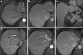 Liver Imaging Reporting and Data System (LI-RADS) treatment response
(LR-TR) Viable after transarterial chemoembolization. MRI scans in a
75-year-old male patient with hepatitis C–related cirrhosis show (A)
a 3.3-cm observation in segment II of the liver that demonstrates arterial
phase hyperenhancement (arrow), plus washout and capsule (not shown),
categorized as LI-RADS 5. (B) Arterial phase MRI scan 1 month after
transarterial chemoembolization shows no residual intralesional enhancement
(arrow), and (C) there is smooth perilesional enhancement without masslike
areas of enhancement (arrow), yielding LR-TR Nonviable. One year following
transarterial chemoembolization, (D) noncontrast MRI scan shows a new 4.5
× 1.0-cm area of irregular T1 hypointense signal (arrows) with (E)
masslike enhancement (arrows) and (F) washout and capsule (arrows) along the
margin of the previous transarterial chemoembolization–treated
hepatocellular carcinoma, yielding LR-TR Viable.
