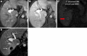 Liver Imaging Reporting and Data System (LI-RADS) treatment response
(LR-TR) Nonviable after microwave ablation (MWA). MRI scans in a 62-year-old
male patient with cirrhosis who presented with a 2.4-cm LI-RADS 5
observation in segment V show (A) arterial phase hyperenhancement (arrow)
and (B) portal venous phase washout with capsule (arrow). (C) Patient
underwent microwave ablation, and MRI scan 3 months later shows a 3.2-cm
treatment cavity demonstrating intrinsic T1 precontrast hyperintense signal
secondary to coagulation necrosis (red arrow). Note the treatment cavity is
8–10 mm larger than the tumor itself to ensure adequate treatment of
microscopic disease surrounding the tumor. (D) Arterial phase MRI scan shows
no intralesional masslike enhancement and smooth perilesional enhancement,
categorized as LR-TR Nonviable (arrow). Note the surrounding perfusional
changes.