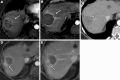 Liver Imaging Reporting and Data System (LI-RADS) treatment response
(LR-TR) Viable after transarterial radioembolization. MRI scans in a 58-year
old male patient with (A) biopsy-proven LR-M (peripheral rim enhancement at
arterial phase with progressive enhancement at portal venous and delayed
phase) hepatocellular carcinoma in segment VIII (arrow). Arterial phase
images (B) 3 months and (C) 9 months after transarterial radioembolization
show no intralesional enhancement and smooth perilesional rim enhancement
without masslike enhancement (arrow), yielding LR-TR Nonviable. (D) MRI
scans 15 months after transarterial radioembolization show a new nodular
area of arterial phase hyperenhancement along the 7 o’clock aspect of
the treatment cavity (arrow), which demonstrates (E) washout (arrow) on the
portal venous phase image, yielding LR-TR Viable.