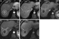 Liver Imaging Reporting and Data System (LI-RADS) treatment response
(LR-TR) Nonviable after transarterial radioembolization. Arterial phase MRI
scans in a 48-year-old female patient show a LI-RADS 5 observation (circle)
in segment VII/VI of the liver ([A] arterial phase hyperenhancement and [B]
washout and capsule). Arterial phase MRI scans (C) 3 months, (D) 9 months,
and (E) 15 months after transarterial radioembolization show no masslike
intralesional enhancement and smooth perilesional rim enhancement (arrow),
yielding LR-TR Nonviable at all time points. Note the surrounding
wedge-shaped parenchymal perfusional changes corresponding to the vascular
distribution, compatible with radiation fibrosis and the slowly developing
parenchymal atrophy from fibrosis.
