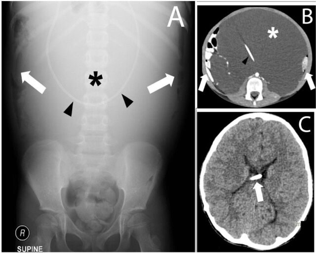 Ventriculoperitoneal shunt-associated abdominal cerebrospinal fluid ...