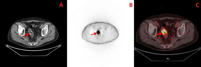 Axial plane; A- CT image highlighting the rectal tumour; B- PET image; C- Fused PET-CT image