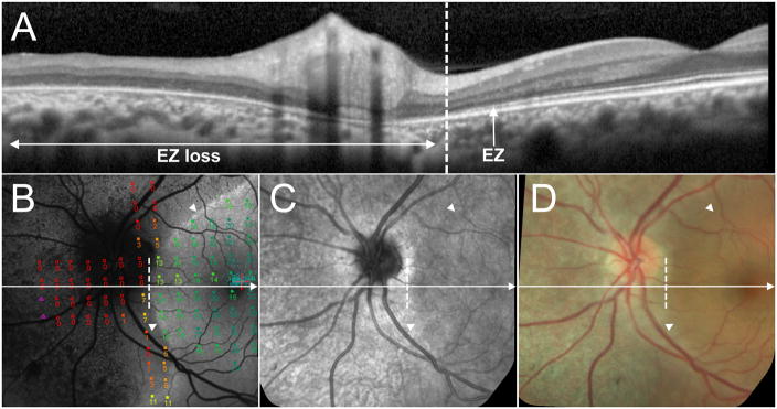 Acute Zonal Occult Outer Retinopathy: Structural and Functional ...