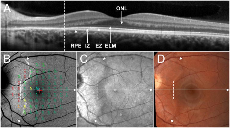 Acute Zonal Occult Outer Retinopathy: Structural and Functional ...