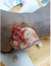 <b>Fig. 1</b>: Presentation of total talus dislocation with the
talus exposed in its entirety from a contaminated
wound at the anterolateral aspect of the ankle.