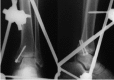 <b>Fig. 2</b>: Operative radiographs showing reduction of the talus and
fixation of the medial malleolus.