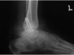 <b>Fig. 4</b>: Radiograph taken six months post-trauma showing no
evidence of avascular necrosis.