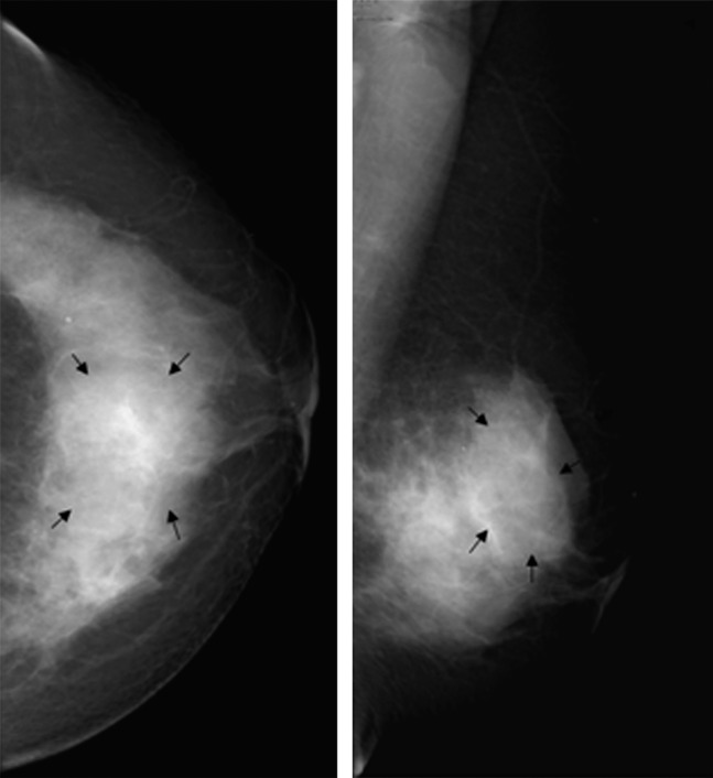 Radiological and clinical features of adult non-puerperal mastitis - PMC