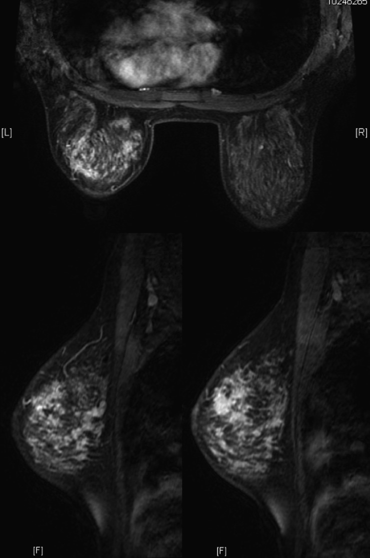 Radiological and clinical features of adult non-puerperal mastitis - PMC