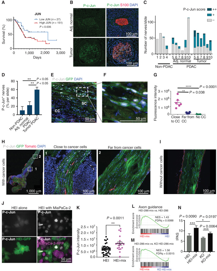 Figure 4. Cancer cells induce SC c-Jun activation and reprogramming. A, Kaplan–Meier curve of overall survival with high or low JUN expression in TCGA PAAD patients. B, P-c-Jun staining in S100-labeled nerves from PDAC specimens that are close to tumor as compared with nerves from adjacent (Adj.) normal tissue. Scale bars, 20 μm. C and D, Assessment of nerves from within pancreatic specimens of non-PDAC pathology, PDAC, and the normal tissues adjacent to PDAC. C, Quantification of the number of nerves per slide with no (-), low (+)-, or high (++)-intensity P-c-Jun staining. Each x-axis number represents a patient. D, Percentage of P-c-Jun–positive nerves (scored + or ++) in the pancreatic specimens of non-PDAC pathology, PDAC, and the normal tissues adjacent to PDAC (non-PDAC, n = 4; PDAC and adjacent normal, n = 6 each; mean ± SEM). E and F, Immunofluorescence of P-c-Jun (white) in a Panc02-injected murine sciatic nerve expressing GFP+ SCs. P-c-Jun is expressed in the green SCs but not in the Panc02 cancer cells (CC). Scale bars, 50 μm. G, Quantification of P-c-Jun fluorescence intensity in SCs of uninjected nerves and in SCs close to or far from injected Panc-02 tumor cells (near tumor: n = 6; far from tumor: n = 4; PBS-injected: n = 7; mean ± SEM, representative of three independent experiments). Fluorescence intensity is the mean intensity measured per area of nerve covered by green SCs. H, P-c-Jun staining in a sciatic nerve injected with Panc-02. (1) Region adjacent to the tumor. (2) Region far from the tumor. Scale bars, 1,000 and 100 μm. I, P-c-Jun staining in a normal nerve without cancer cells. Scale bar, 100 μm. J, Immunofluorescence of P-c-Jun in HEI-286 GFP SCs grown alone or grown mixed with MiaPaCa-2-RFP. Top images show P-c-Jun staining alone in HEI-286 SCs alone (left) and cocultured HEI-286 mixed with MiaPaCa-2 (right). Bottom overlay images allow identification of HEI-286 SCs (green) and MiaPaCa-2 (magenta). Scale bar, 50 μm. K, Quantification of P-c-Jun fluorescence intensity in HEI-286 SCs grown alone or mixed with MiaPaCa-2. Mean fluorescence intensity was measured per HEI-286 SC (n > 15 cells/group, mean ± SEM, representative of three independent experiments). L and M, GSEA assessing axon guidance genes in cancer cocultured HEI-286 SCs compared with HEI-286 SCs alone (L and in cancer cocultured HEI-286 compared with cancer cocultured c-Jun KO HEI-286 SCs (M). NES, normalized enrichment score. N, IPAS scores for the axon guidance genes (KEGG 2019).