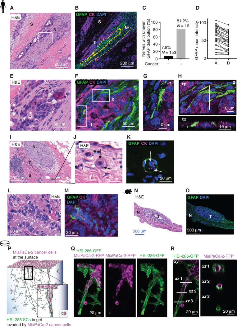 Figure 2. SCs wrap and align cancer cells. A, Hematoxylin and eosin (H&E) section of a human PDAC specimen with PNI. Scale bar, 200 μm. N, nerve; S, stroma; T, tumor. B, GFAP (green) and cytokeratin (CK; magenta) staining in a section adjacent to A showing cancer cells surrounded by GFAP+ SCs in a nerve. The yellow and orange dotted regions of the nerve are adjacent (A) or distal (D) to the cancer cells. Scale bar, 200 μm. C, Quantification of nerves with an uneven GFAP distribution comparing when cancer is visibly present or absent. D, Quantification of GFAP mean intensity in adjacent and distal regions of nerves (paired t test, P < 0.0001). E, Enlargement of rectangle in A. Scale bar, 50 μm. F, GFAP and CK staining of an adjacent section of E. Scale bar, 50 μm. G, Confocal images corresponding to rectangle 1 in F. Scale bar, 10 μm. H, Confocal images corresponding to rectangle 2 in F. Top image is an xy maximum projection, and the bottom image is an xz image corresponding to the dotted line. Scale bars, 10 μm. I, H&E section of a human PDAC specimen with a nerve (N) and tumor cells (T) in the neighboring stroma (S). Scale bar, 200 μm. J, Enlargement of I. Arrows indicate two cancer cells. Scale bar, 20 μm. K, GFAP and CK staining of a section adjacent to J showing GFAP+ SCs wrapping two cancer cells (arrows). Scale bar, 20 μm. L and M, H&E staining and adjacent GFAP and CK staining of a human PDAC specimen showing GFAP+ SCs around aligned cancer cells. Scale bars, 20 μm. N and O, H&E staining and adjacent GFAP staining of a longitudinal section of a murine sciatic nerve injected with cancer cells. Scale bars, 500 μm. P, Schematic representation of HEI-286 SCs and MiaPaCa-2 cancer cells in a 3D Matrigel invasion assay. The MiaPaCa-2-RFP cancer cells are placed on the surface of a Matrigel chamber in which HEI-286 SCs have grown. Cancer cells invade the gel as a chain of cancer cells surrounded by HEI-286 SC tracks. Q, Maximum projection of confocal images showing a chain of cancer cells lined up within a tubular structure of HEI-286 SCs in Matrigel. Scale bar, 20 μm. R, Single focal planes of confocal images showing MiaPaCa-2 cancer cells and HEI-286 SCs organized into columns. Longitudinal (left) and transverse (right) images correspond to the indicated positions. Scale bars, 20 μm.