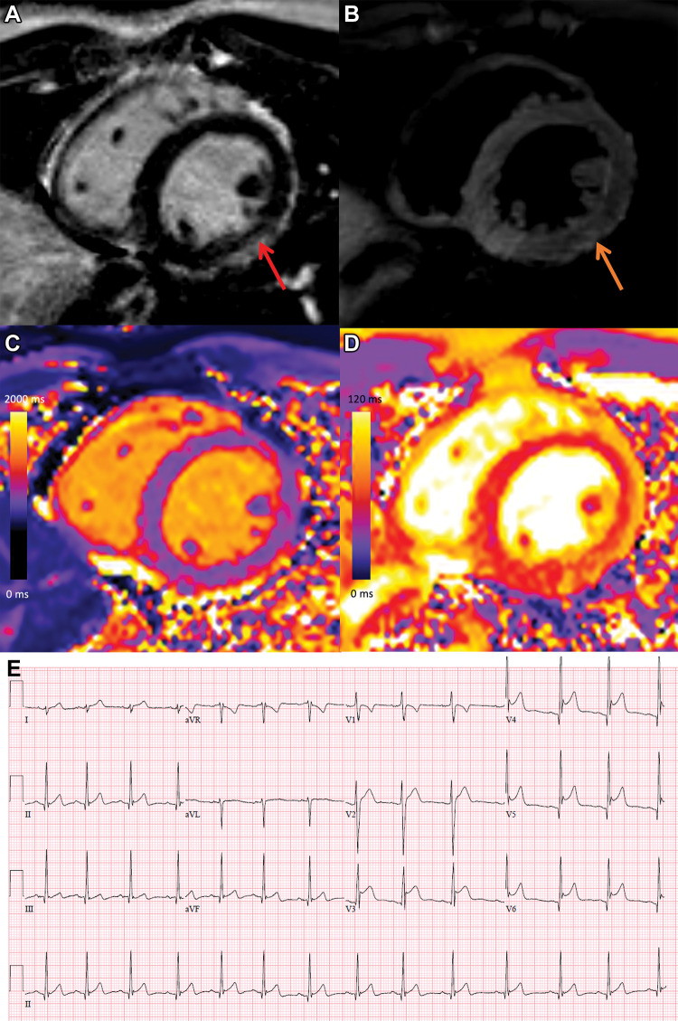 COVID-19 vaccine–associated myocarditis. Short-axis 1.5-T MRI scans and electrocardiographic findings in a 19-year-old man with myopericarditis who presented with chest pain 3 days following the second dose of messenger RNA–1273 COVID-19 vaccine. (A) Cardiac MRI late gadolinium enhanced scan obtained 2 days after symptom onset demonstrates midwall to subepicardial late gadolinium enhancement at the basal to mid-inferior lateral wall with adjacent pericardial enhancement (arrow). (B) T2-weighted MRI scan shows corresponding hyperintensity (arrow). (C, D) Parametric maps show abnormal high native T1 (C, 1095 msec, maximum region of interest) and abnormal high native T2 (D, 57 msec, maximum region of interest). (E) Electrocardiogram demonstrates diffuse concave upward ST-segment elevation except in leads aVR and V1, upright T waves in the leads with ST-segment elevation, and PR depression consistent with pericarditis. The peak high-sensitivity troponin I level was 5772 pg/mL. The patient was admitted to the hospital and discharged after 2 days following complete resolution of symptoms and was asymptomatic with normal troponin levels at short-term follow-up.