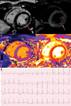 COVID-19 vaccine–associated myocarditis. Short-axis 1.5-T MRI
scans and electrocardiographic findings in a 19-year-old man with
myopericarditis who presented with chest pain 3 days following the second
dose of messenger RNA–1273 COVID-19 vaccine. (A) Cardiac MRI late
gadolinium enhanced scan obtained 2 days after symptom onset demonstrates
midwall to subepicardial late gadolinium enhancement at the basal to
mid-inferior lateral wall with adjacent pericardial enhancement (arrow). (B)
T2-weighted MRI scan shows corresponding hyperintensity (arrow). (C, D)
Parametric maps show abnormal high native T1 (C, 1095 msec, maximum region
of interest) and abnormal high native T2 (D, 57 msec, maximum region of
interest). (E) Electrocardiogram demonstrates diffuse concave upward
ST-segment elevation except in leads aVR and V1, upright T waves in the
leads with ST-segment elevation, and PR depression consistent with
pericarditis. The peak high-sensitivity troponin I level was 5772 pg/mL. The
patient was admitted to the hospital and discharged after 2 days following
complete resolution of symptoms and was asymptomatic with normal troponin
levels at short-term follow-up.