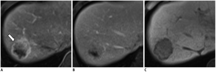 Atypical Appearance of Hepatocellular Carcinoma and Its Mimickers: How ...