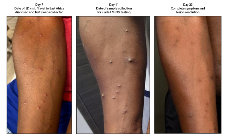 The figure is a series of three photographs illustrating progression of lesions in a patient with clade 1b monkeypox virus infection 7, 12, and 23 days after return to the United States from East Africa in California during 2024.