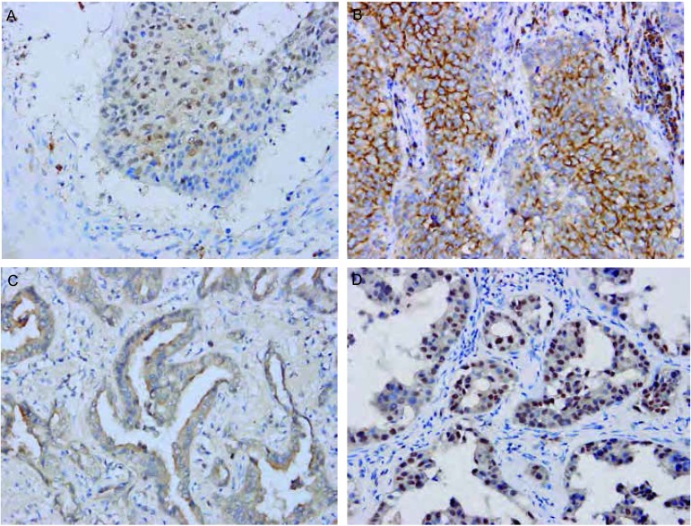 A: Squamous cell carcinoma; B: Lymph node metastases of squamous cell carcinoma; C: Adenocarcinoma; D: Lymph node metastases of adenocarcinoma.