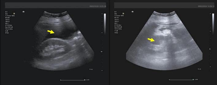 Delayed Bladder Rupture Following Blunt Trauma: A Case Report And 