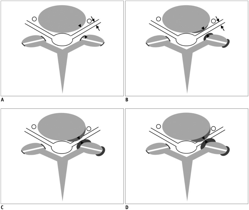 A New Mri Grading System For Cervical Foraminal Stenosis Based On Axial