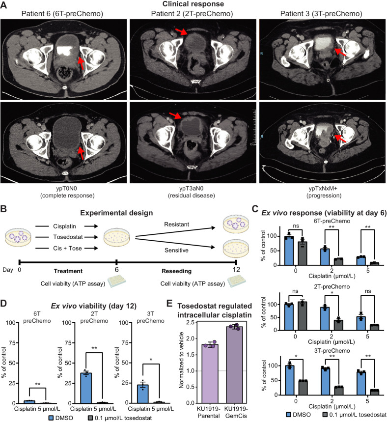 Figure 6. NPEPPS inhibitor tosedostat overcomes cisplatin resistance ex vivo. A, Clinical response to cisplatin-based chemotherapy in three MIBC patients. Pathologic preoperative chemotherapy response is annotated according to pathologic stage following radical cystectomy or metastatic biopsy. Response is illustrated by pre- (top) and posttreatment (bottom) computerized tomography scans. Red arrows, bladder wall thickening and subsequence response. B, Experimental design for treating PDOs with cisplatin and tosedostat alone or in combination. PDOs were withdrawn from treatment, dissociated into single cells, and reseeded after 6 days. Cell viability was measured using CellTiter-Glo at days 6 and 12. C, Ex vivo response of PDOs treated with the indicated concentrations of cisplatin with or without the addition of tosedostat. After 6 days, viability was measured by CellTiter-Glo (biological triplicates; mean ± SEM). D, Cisplatin response in reseeded organoids treated at the indicated concentrations of drug, with viability measured by CellTiter-Glo (biological triplicates; mean ± SEM). E, CyTOF results for KU1919-Parental or -GemCis cells treated with 1 μmol/L tosedostat or DMSO for 72 hours, followed by 10 μmol/L cisplatin for 4 hours. Median values of three replicates were normalized to the vehicle control treatment. One-way ANOVA; *, P < 0.05; **, P < 0.005; ns, nonsignificant.