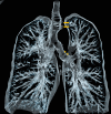 Virtual bronchography of thacheobronchial diverticulosis
