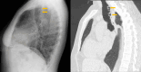Tracheal diverticulosis: sagital CXR and CT comparison