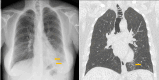 Tracheal diverticulosis and left bronchiolitis; frontal CXR and CT comparison