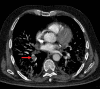 PE in a 73-year-old man with COVID-19. (a) Axial nonenhanced CT image
(lung window) at baseline shows peripherally diffuse ground-glass opacities
in both lungs. (b) Axial contrast-enhanced CT image (lung window) obtained
after 10 days shows increased consolidation in both lungs. Note the
bronchial dilatation within involved portions of the lungs. (c, d) Axial
contrast-enhanced CT image (mediastinal window) (c) and sagittal
reconstruction (d) obtained 10 days after the baseline images show a filling
defect (arrow) in a segmental pulmonary artery branch in the right lower
lobe, consistent with PE.